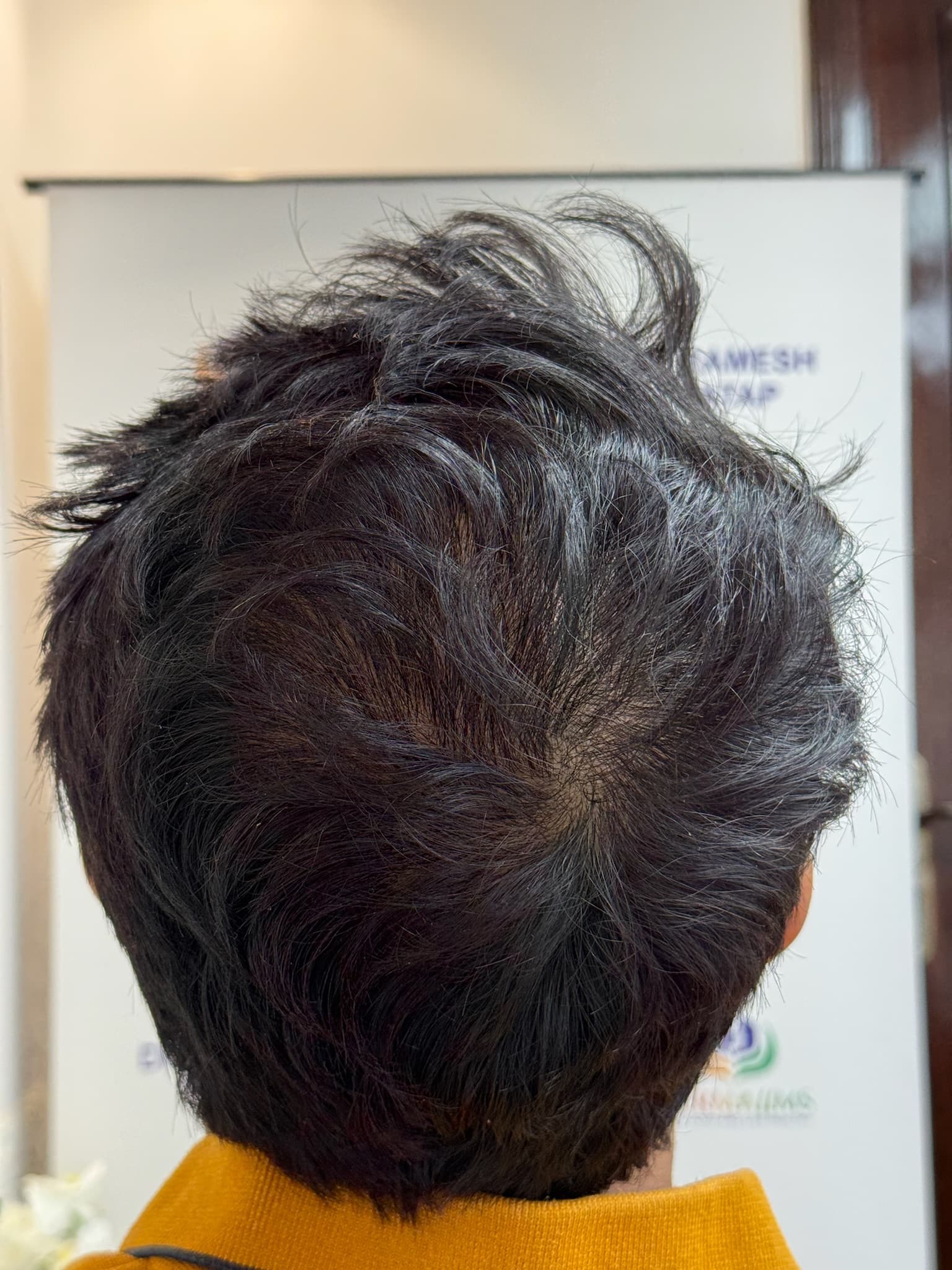 Patient 11 after 4,000 grafts by MY-DHT