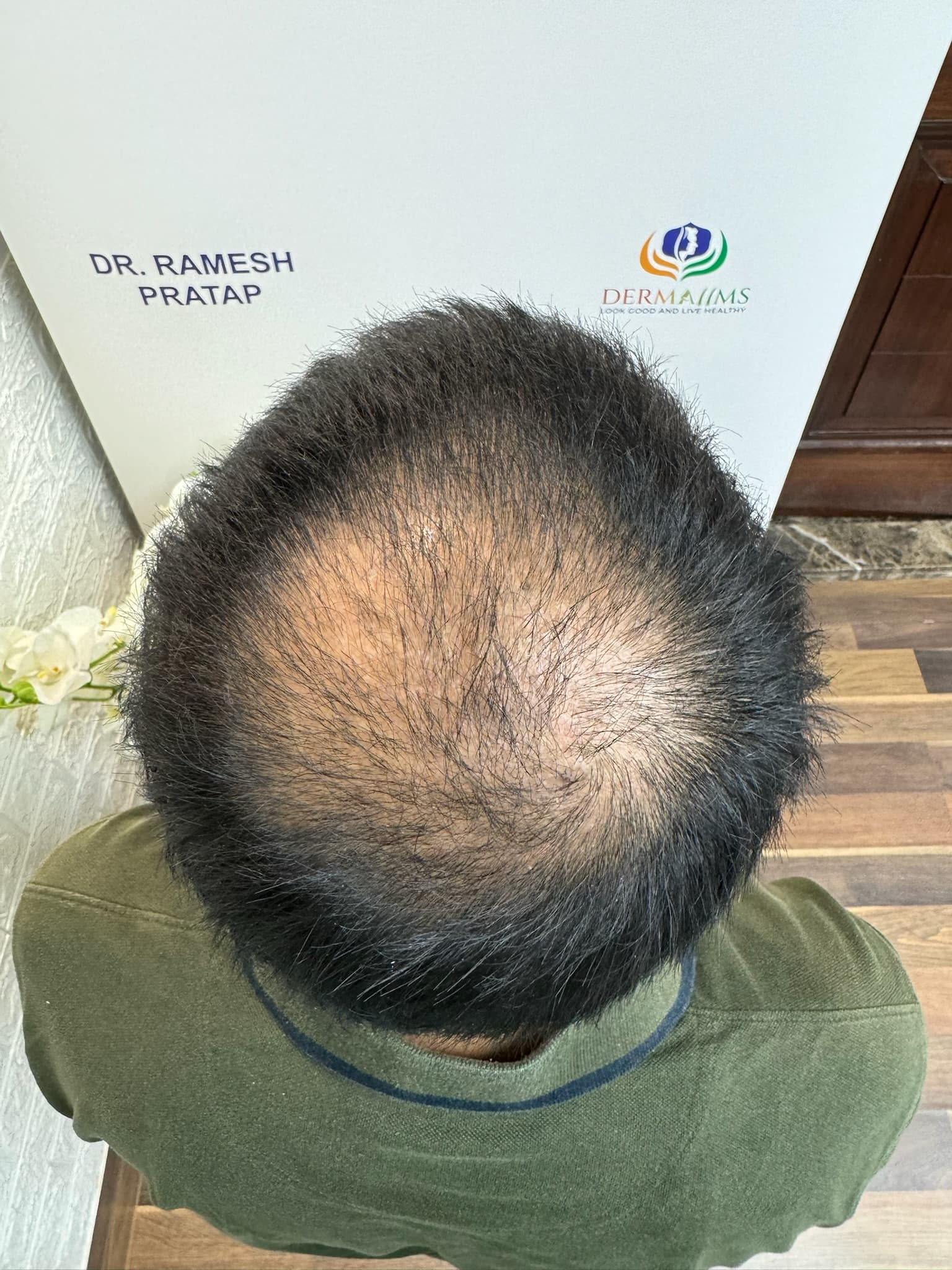 Patient 11 before hair transplant — Norwood Grade III (Vertex)