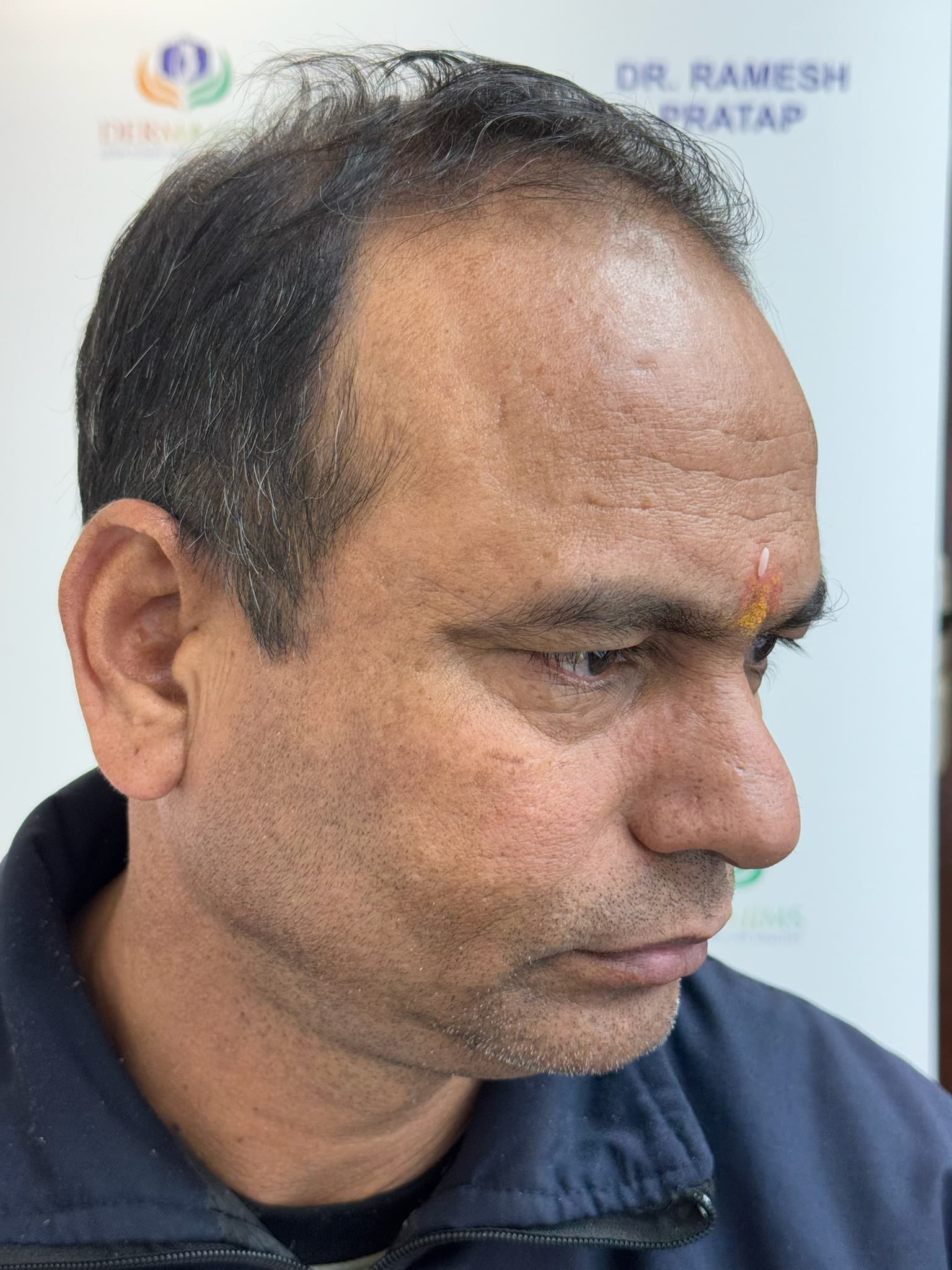Patient 10 before hair transplant — Norwood Grade VI