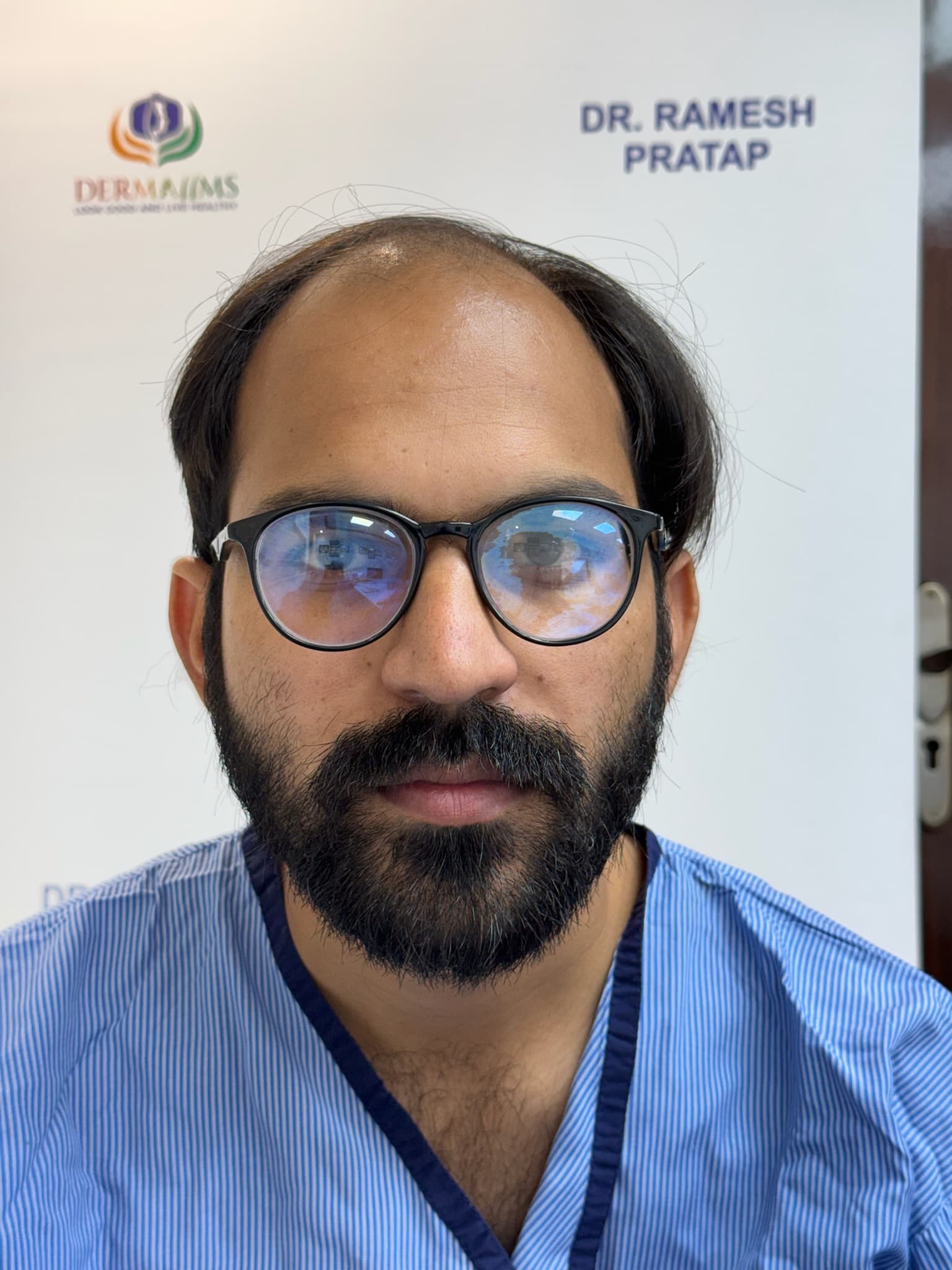 Patient 6 before hair transplant — Norwood Grade IV