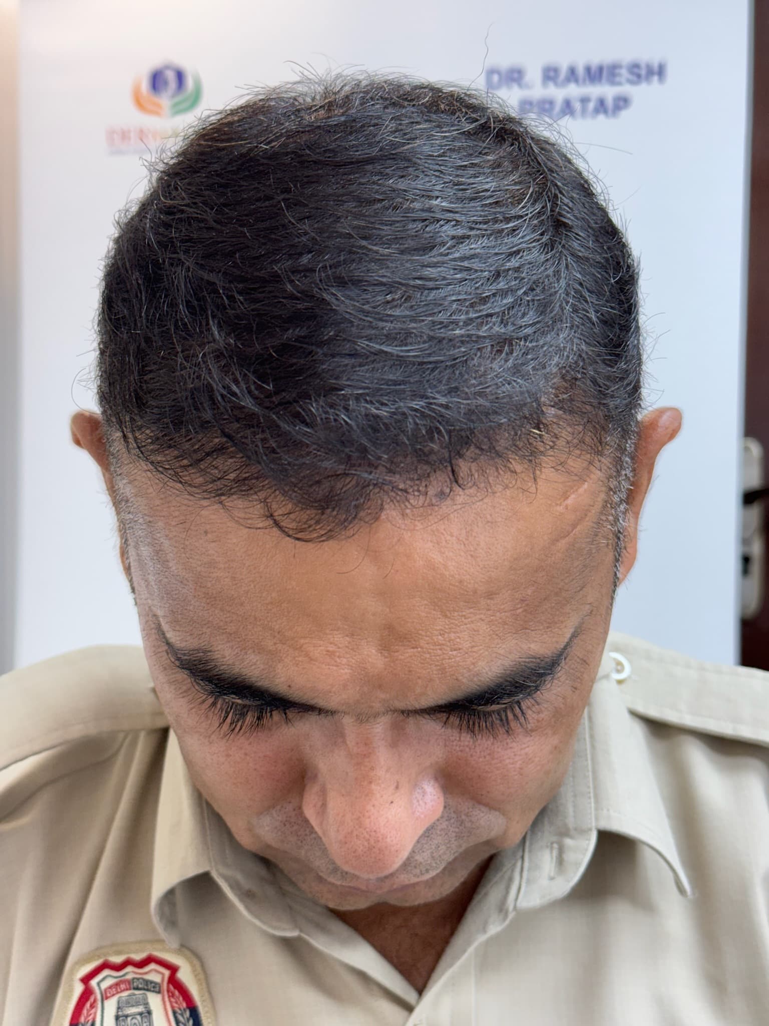 Patient 8 after 4,800 grafts by MY-DHT
