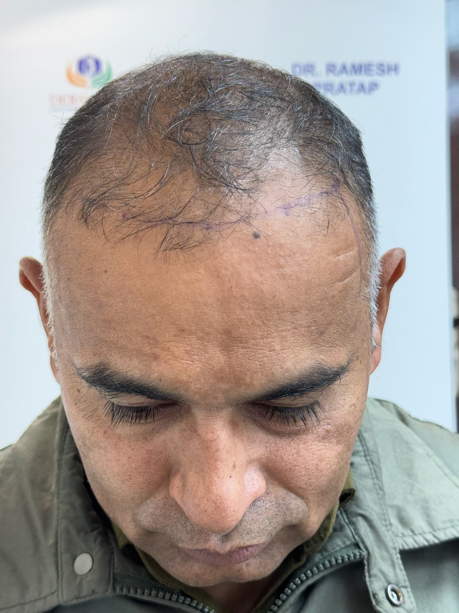 Patient 8 before hair transplant — Norwood Grade V