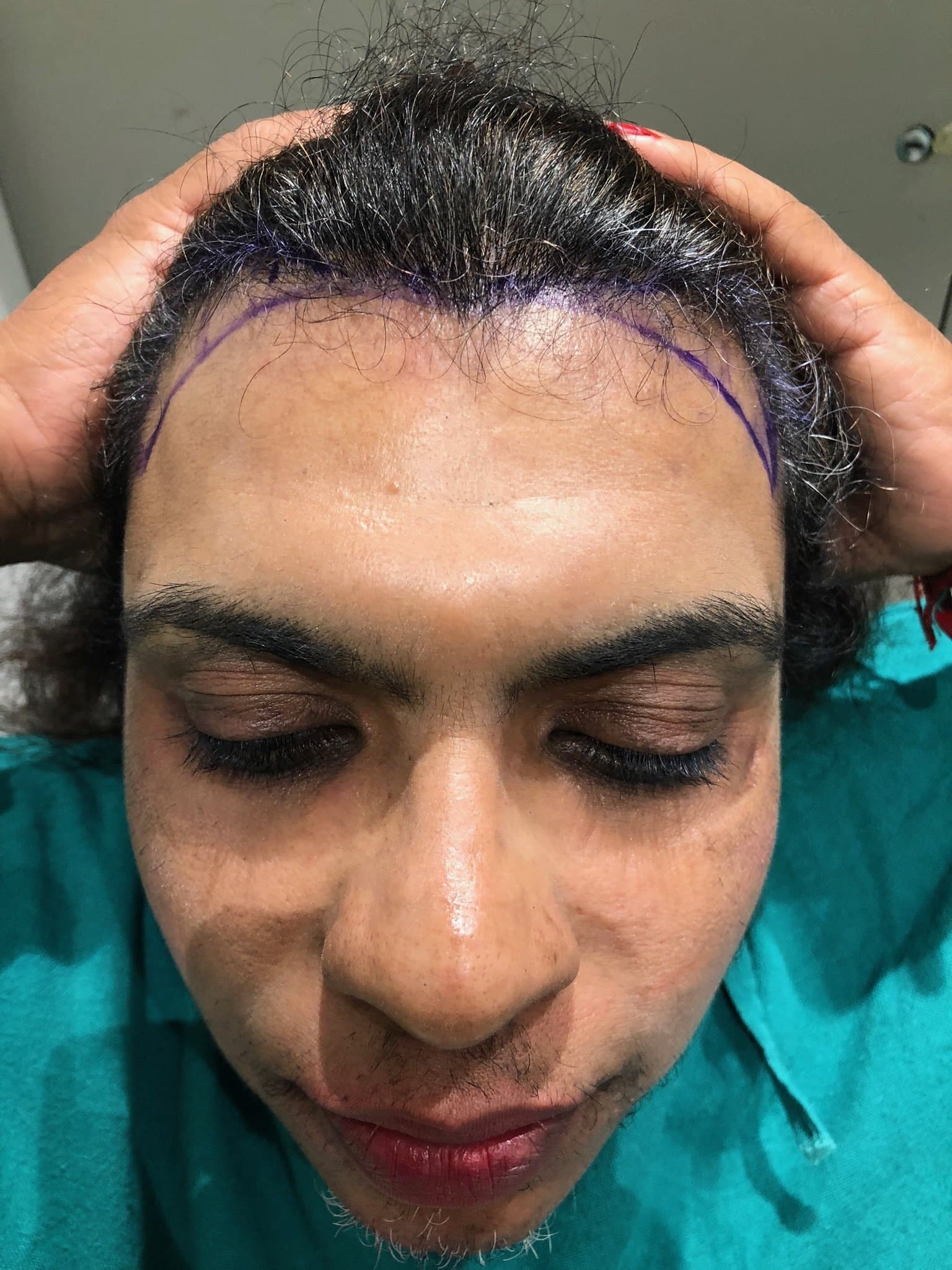 Patient 8 before hair transplant — Norwood Grade II to Natural Female Hairline