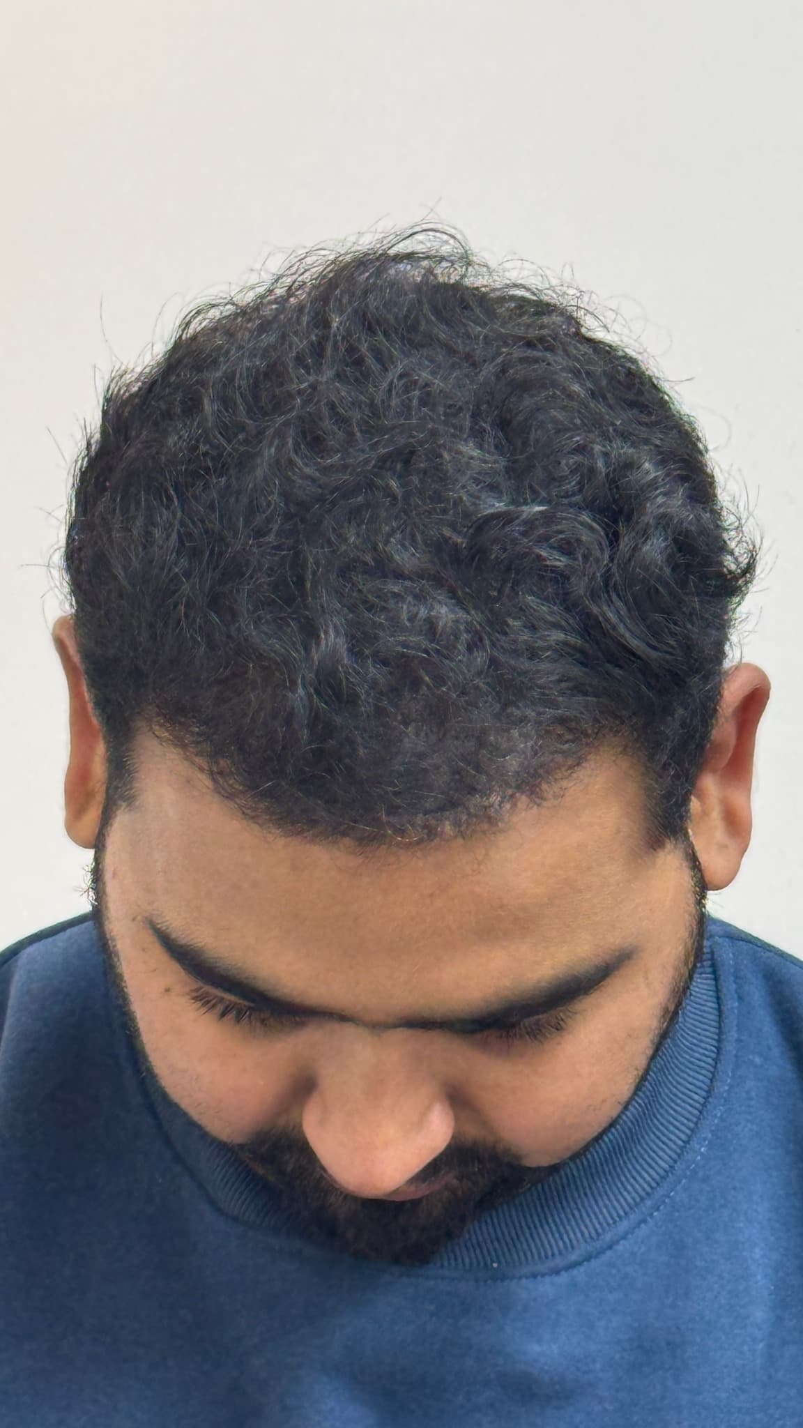 Patient 7 after 5,000 grafts by MY-DHT