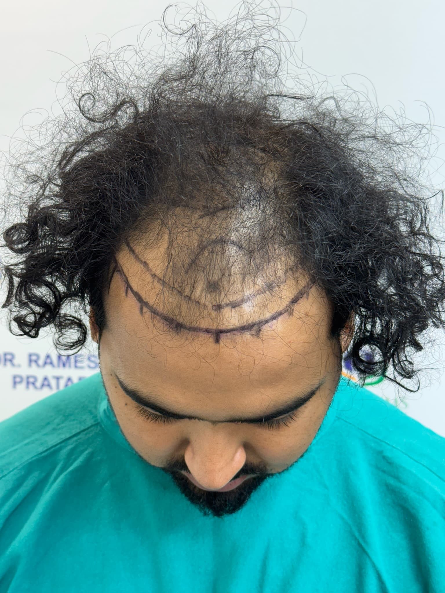 Patient 7 before hair transplant — Norwood Grade V