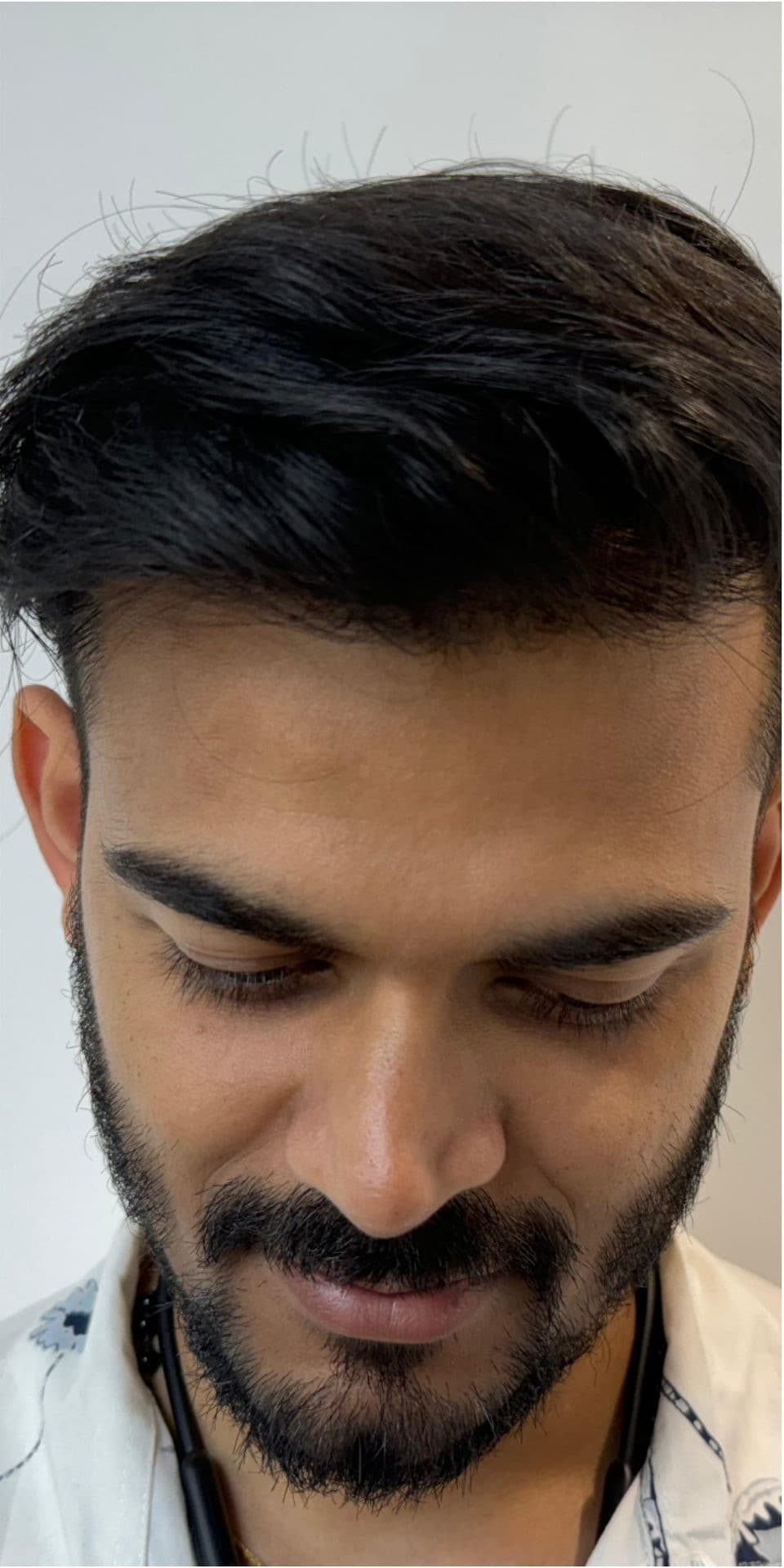 Patient 1 after 4,900 grafts by MY-DHT