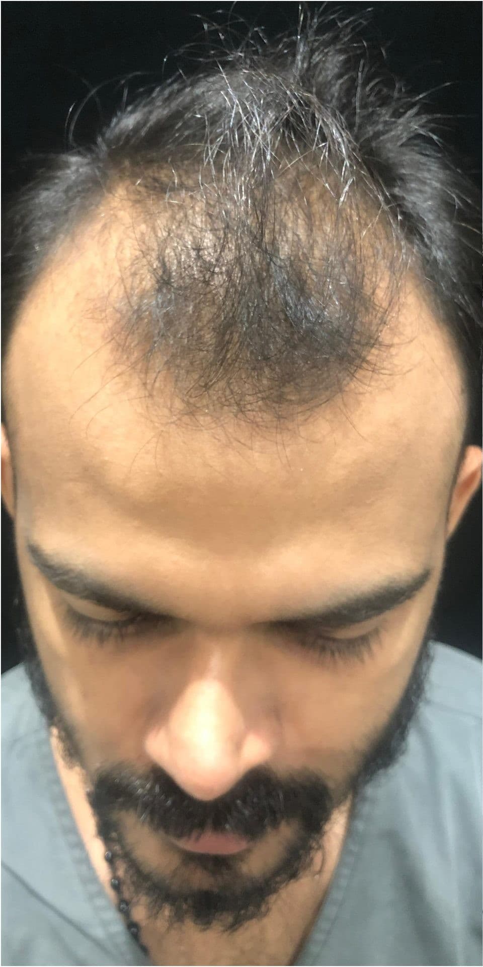 Patient 1 before hair transplant — Norwood Grade V