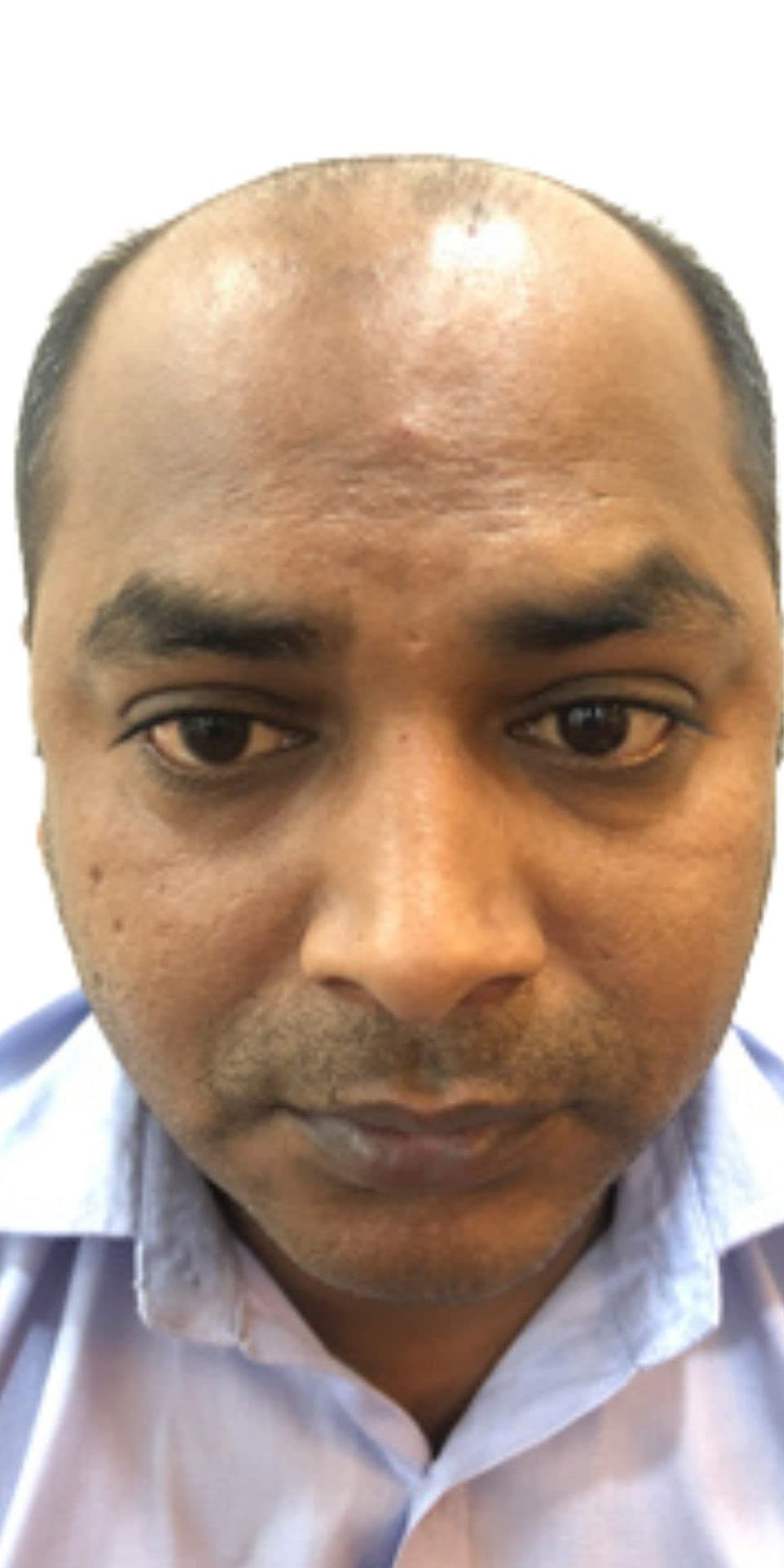 Patient 5 before hair transplant — Norwood Grade VII
