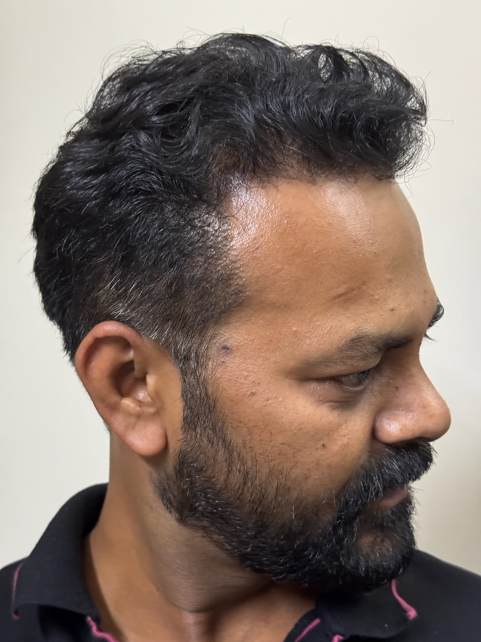 Patient 9 after 3,800 grafts by MY-DHT