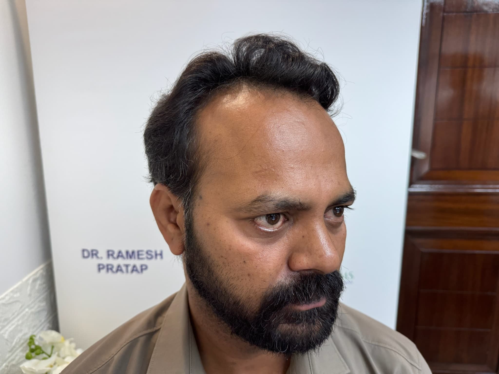 Patient 9 before hair transplant — Norwood Grade IV