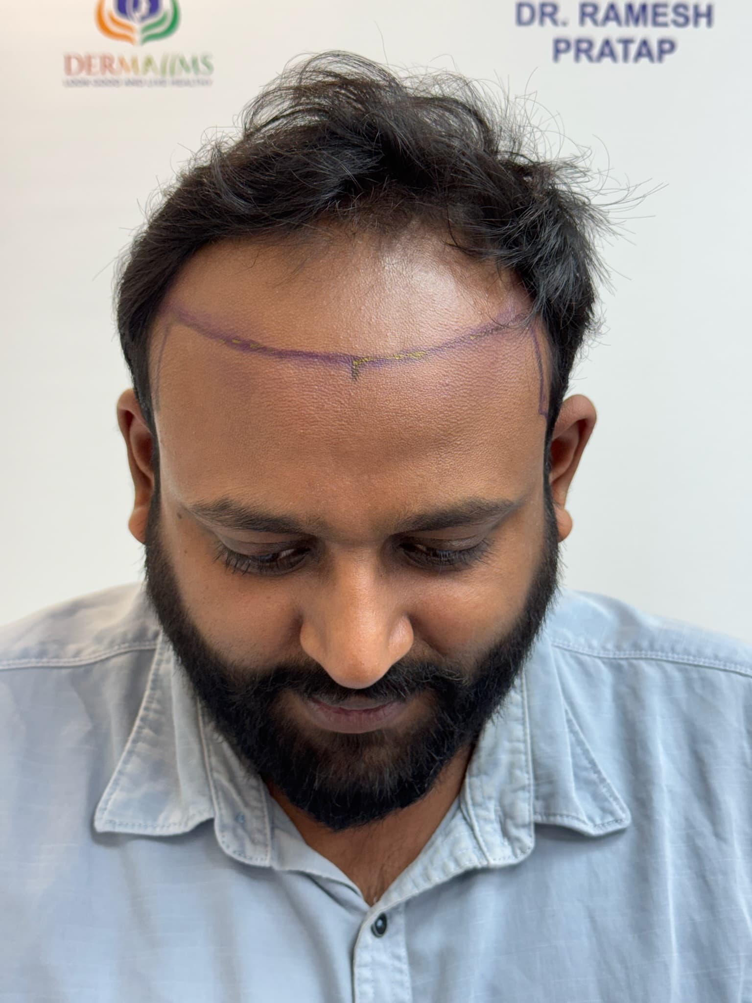 Patient 2 before hair transplant — Norwood Grade V