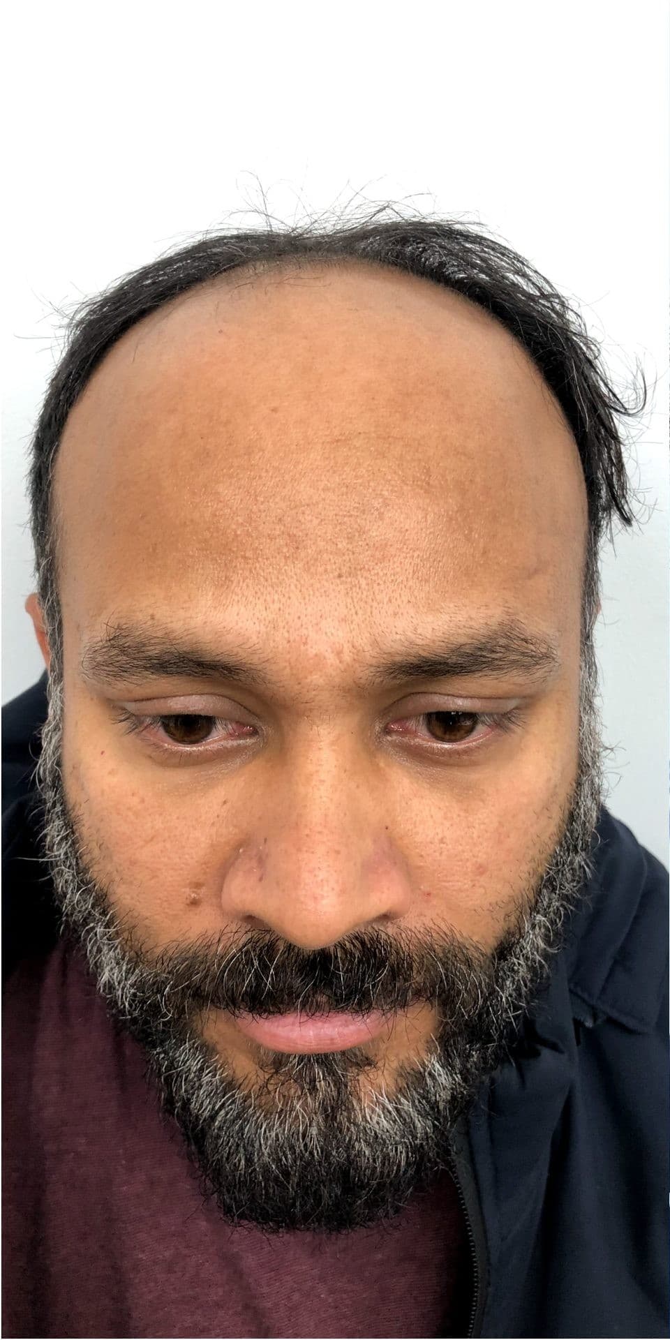 Patient 3 before hair transplant — Norwood Grade VI